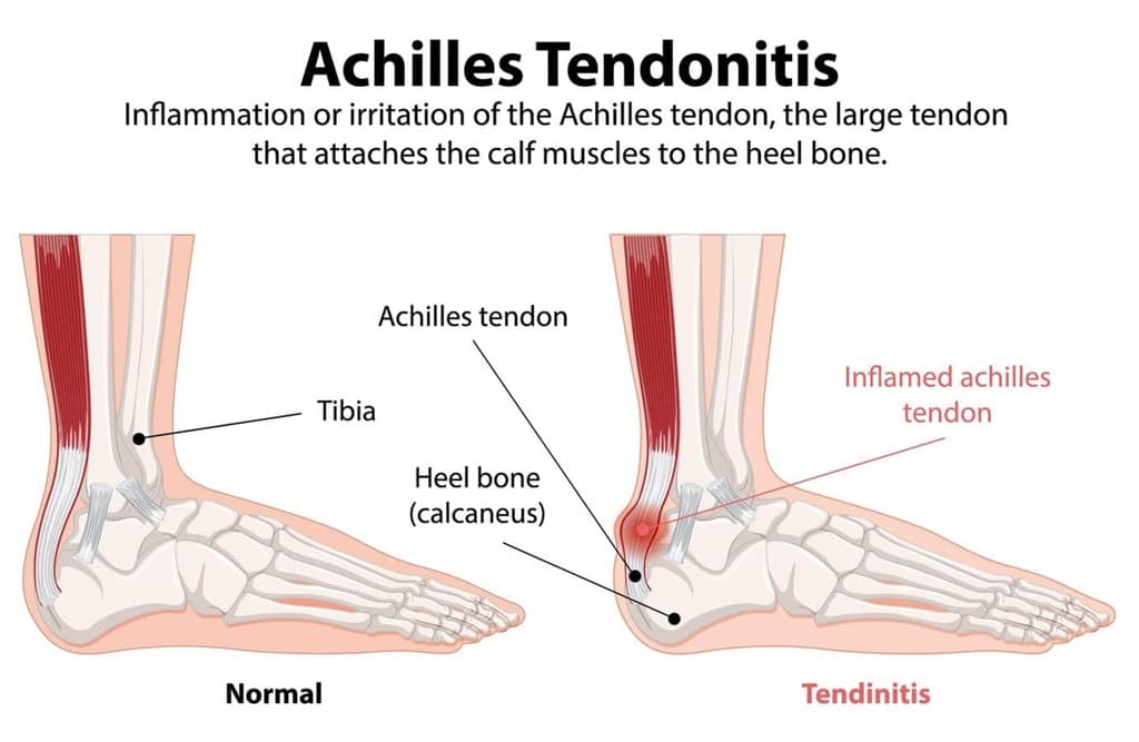 Cure Achilles Tendonitis Fast: Exercises and Treatments